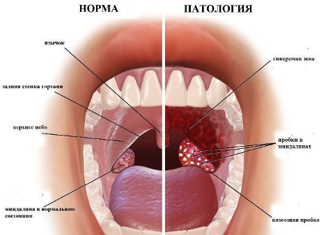 Когда тонзилэктомия не решит проблему