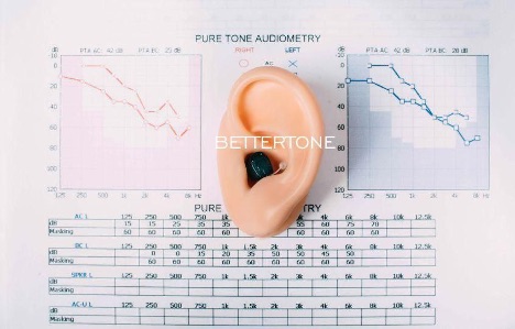 Пациент не слышит, а аудиограмма «почти норма» — не пропустите слуховую агнозию