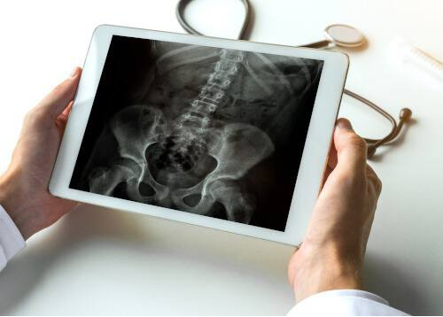 Инновация в спинальной хирургии: Разработано мобильное приложение для прецизионного анализа позвоночника!